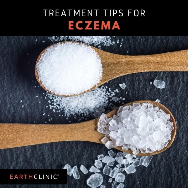 Natural Remedies for Eczema